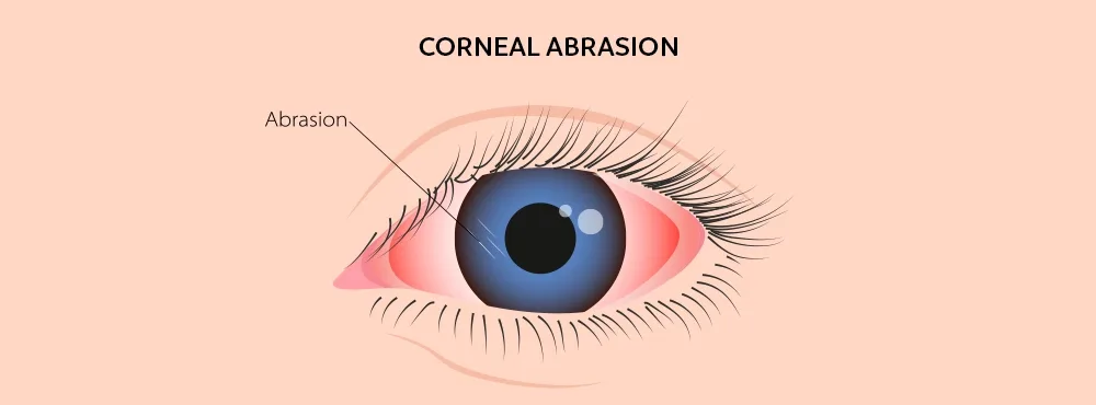 Ocular injuries